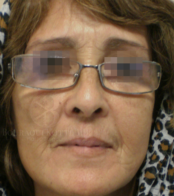 Face Lipofilling Dr Bouraoui Kotti Md