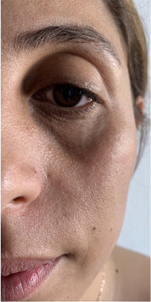 Face Lipofilling Dr Bouraoui Kotti MD