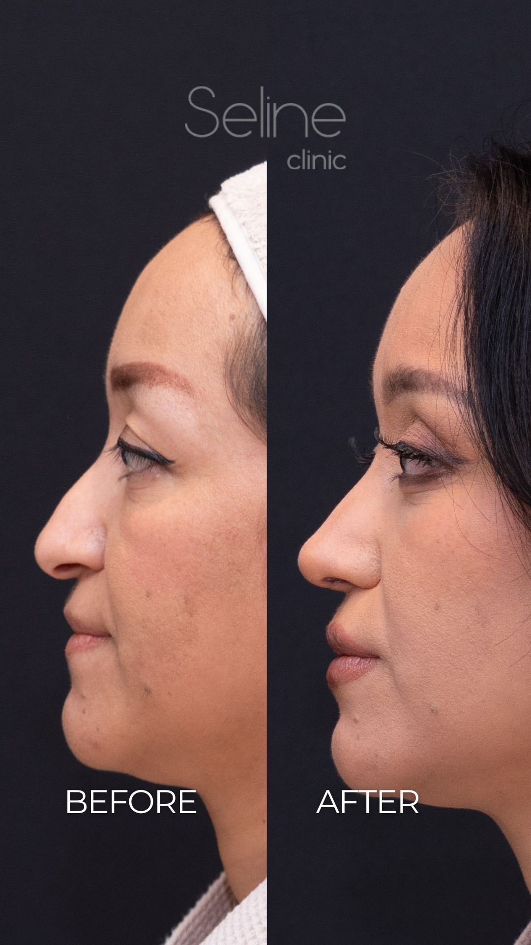 Rhinoplasty