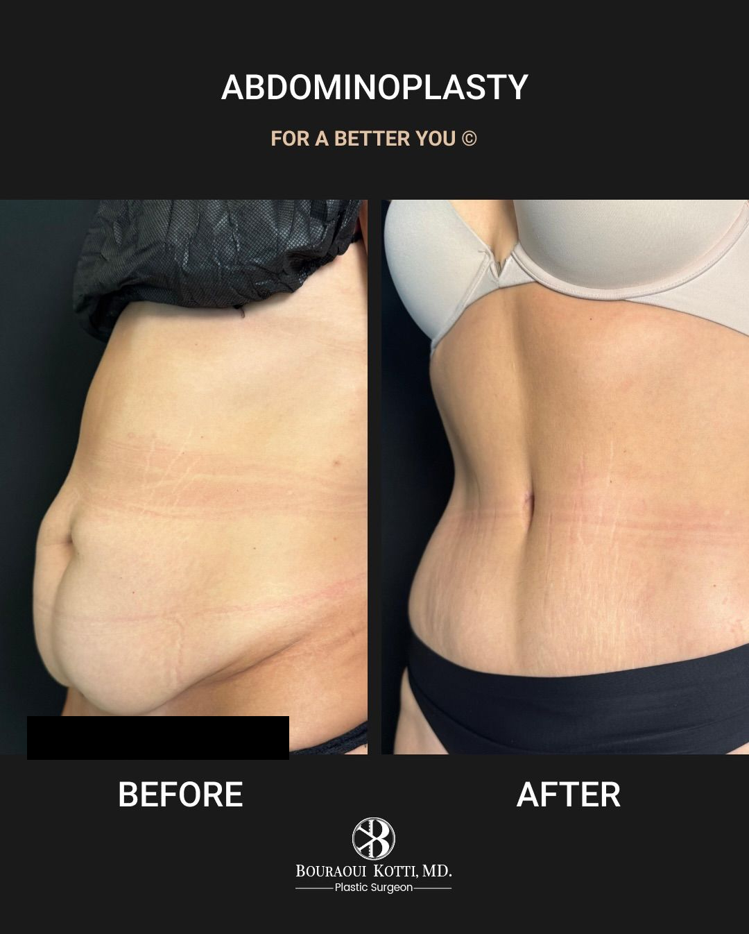 Documented abdominoplasty before-and-after result from an individual clinical case
