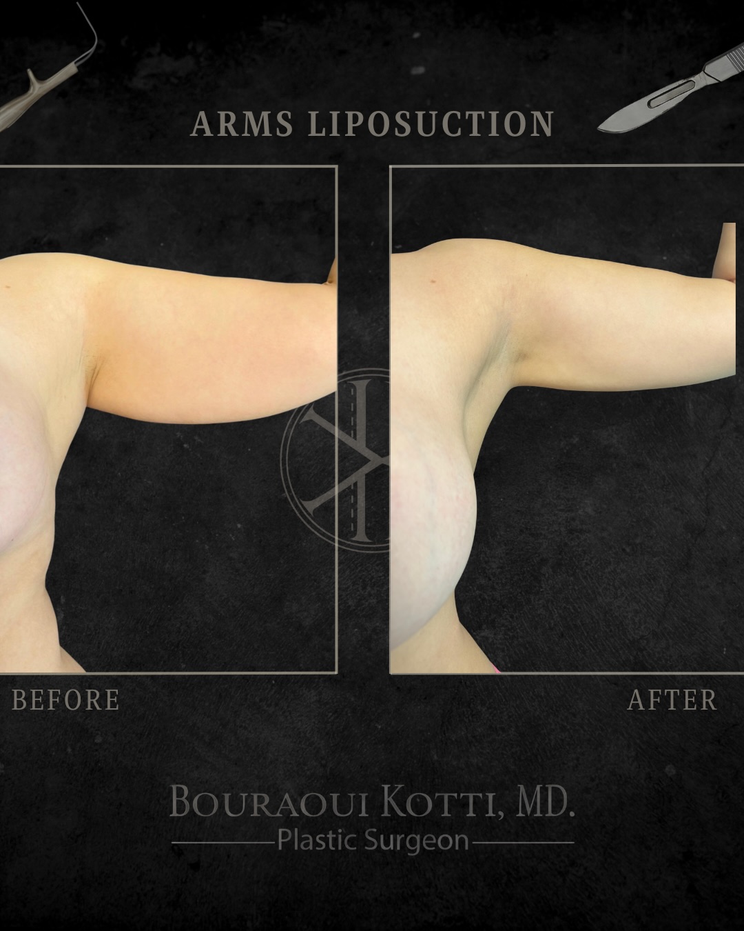 Clinical plastic surgery result — Arms Liposuction