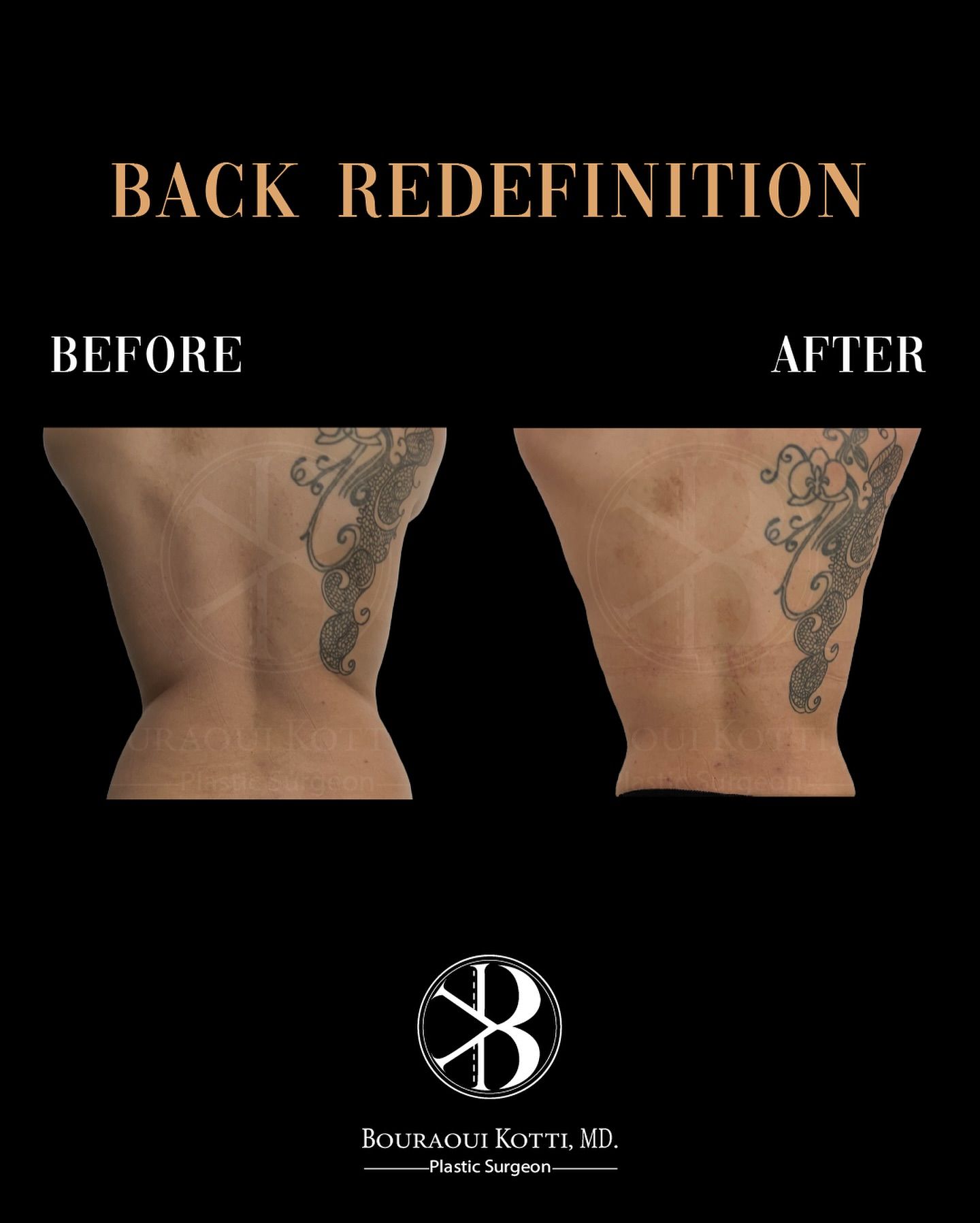 Clinical plastic surgery result — Back Redefinition