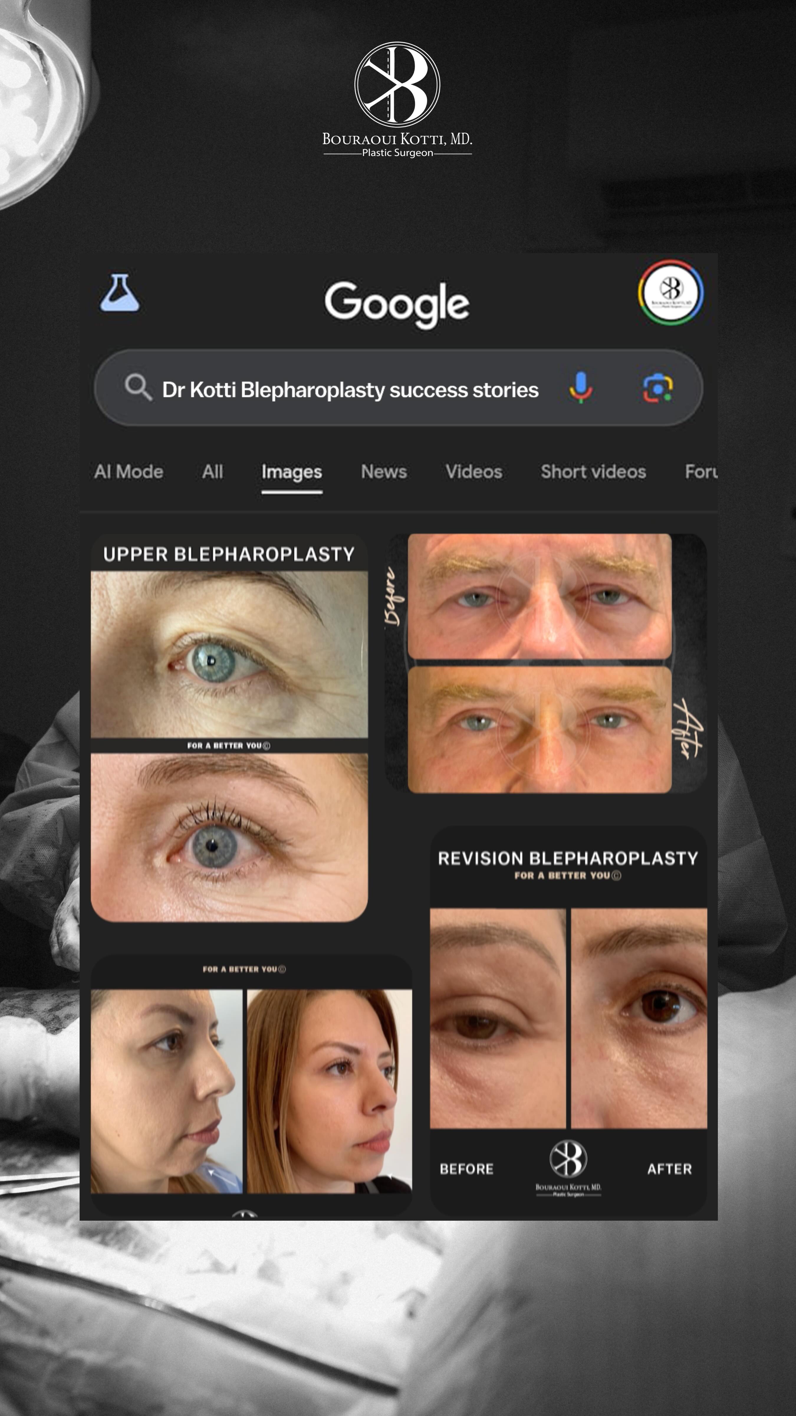 eyelid surgery blepharoplasty before Dubai — drooping eyelids and puffiness clinical view | EBOPRAS Certified Surgeon (8)