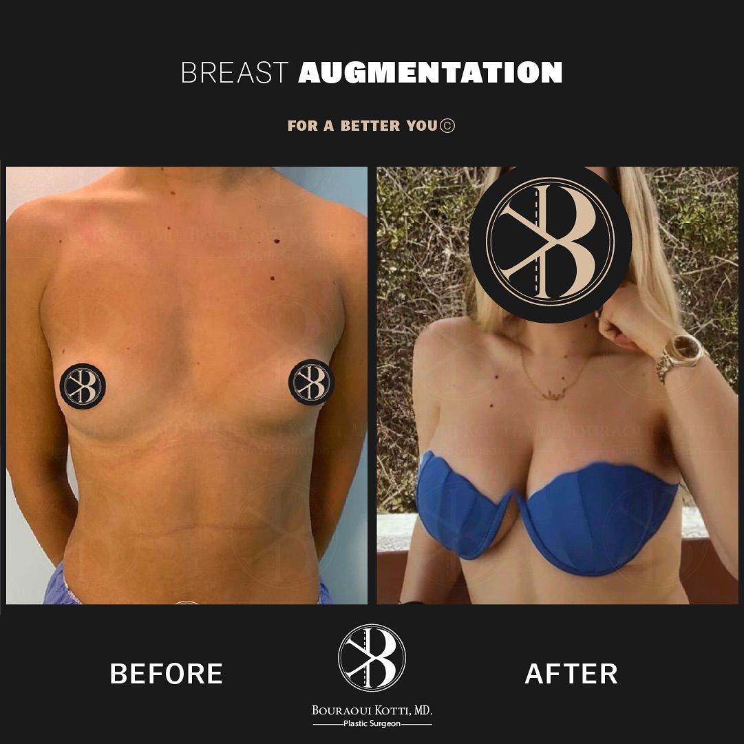 Clinical plastic surgery result — Breast Augmentation
