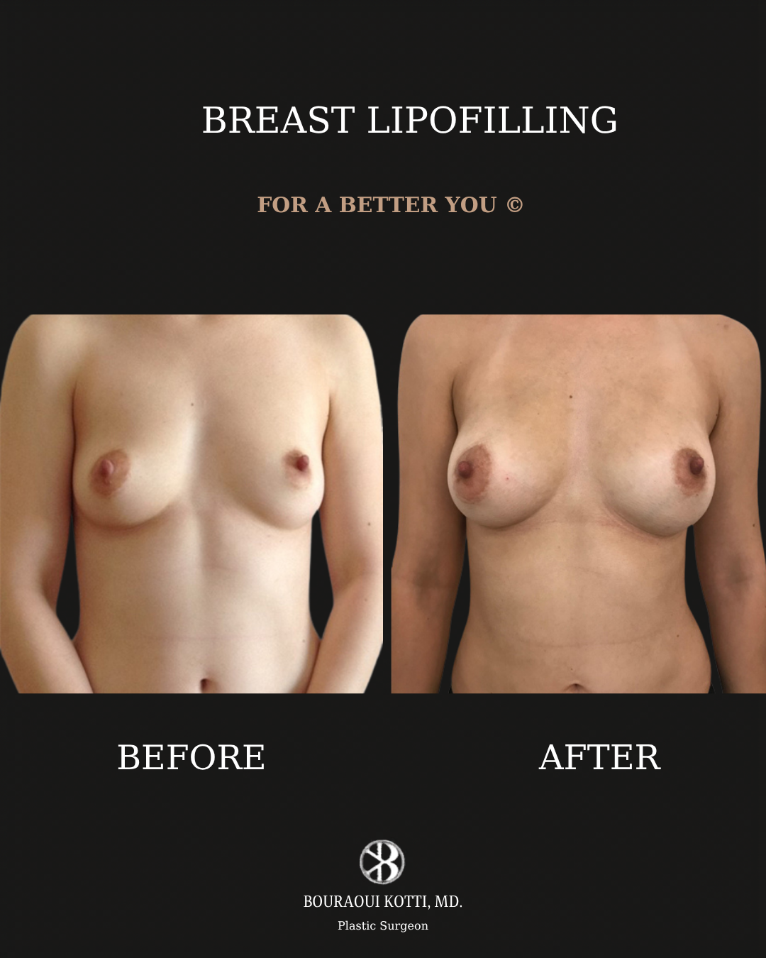 Clinical plastic surgery result — Breast Lipofilling