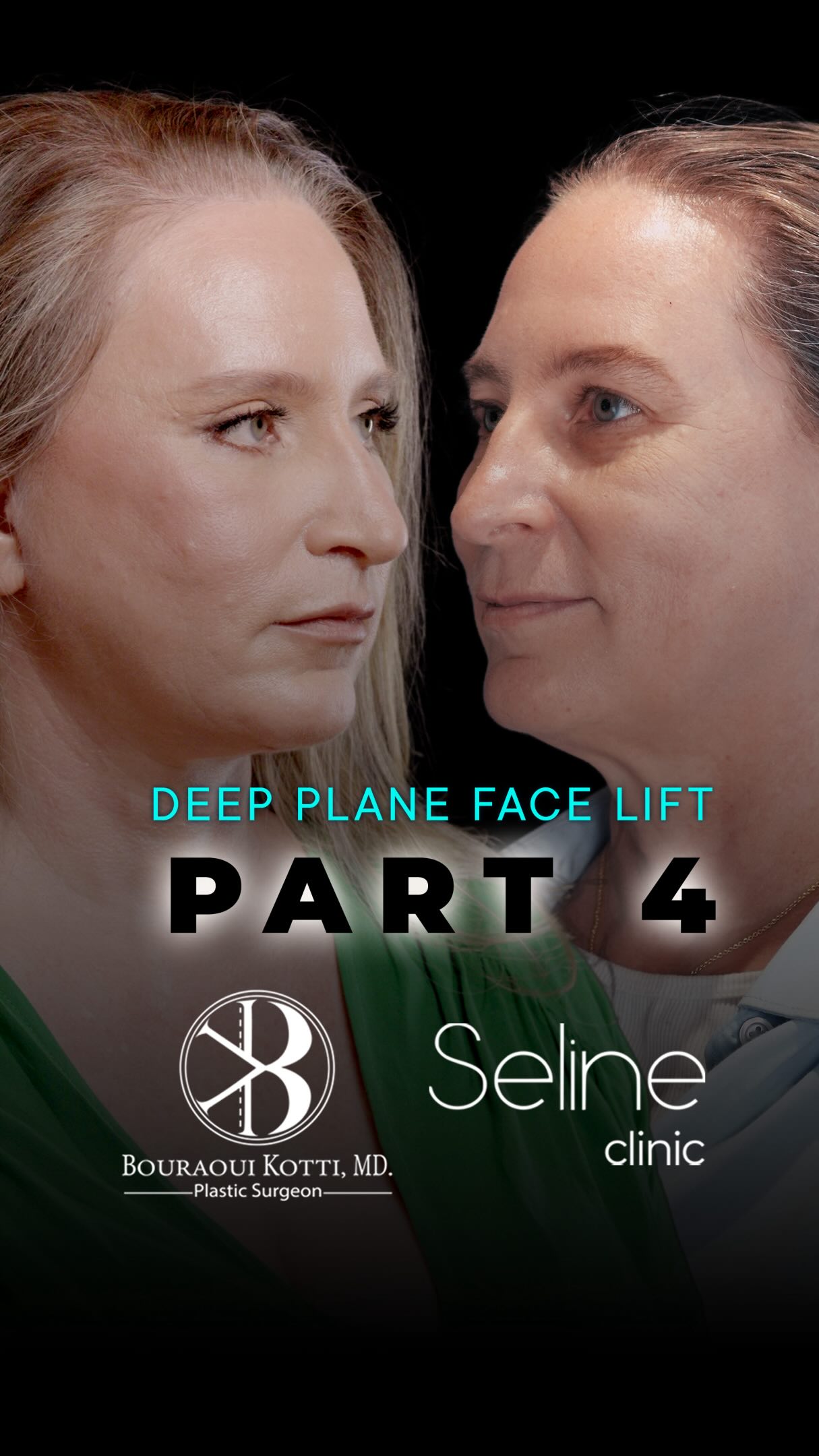Deep plane facelift before · after
