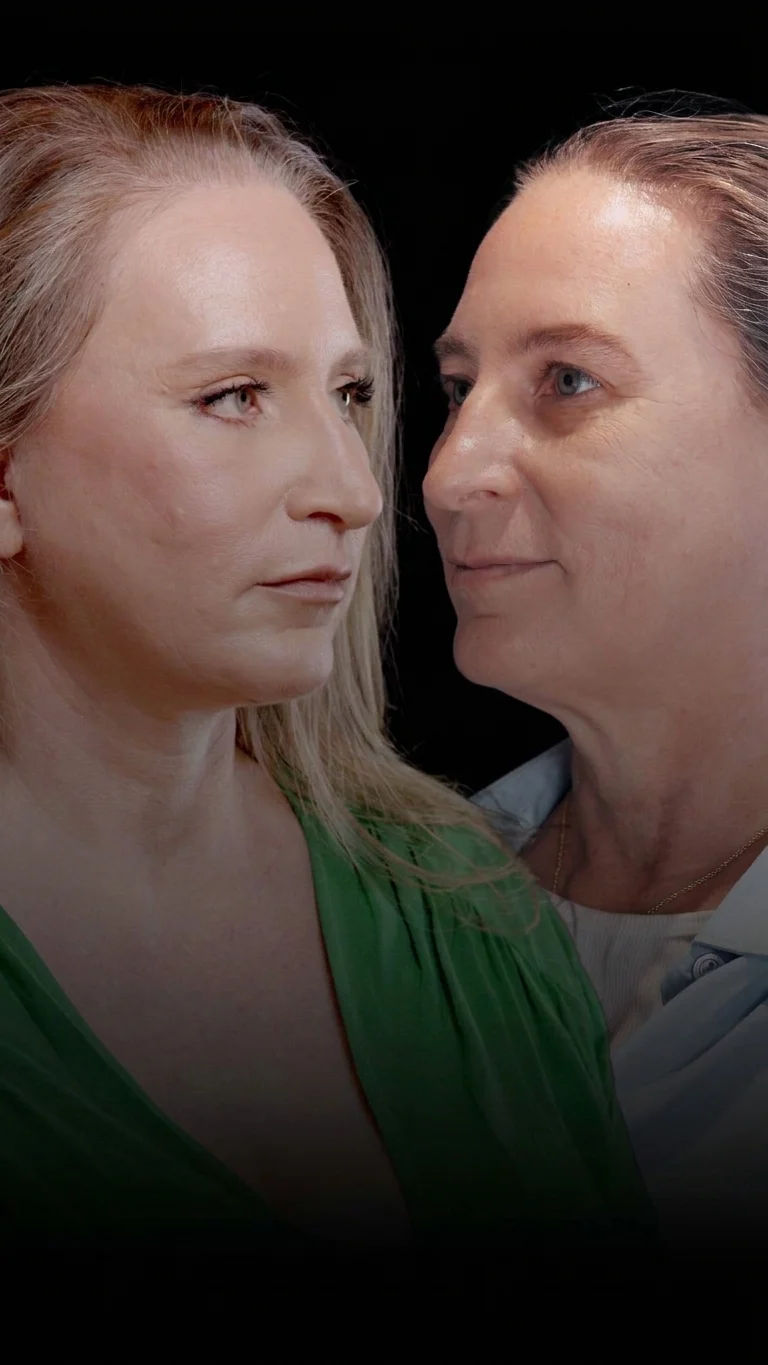 Deep plane facelift before · after
