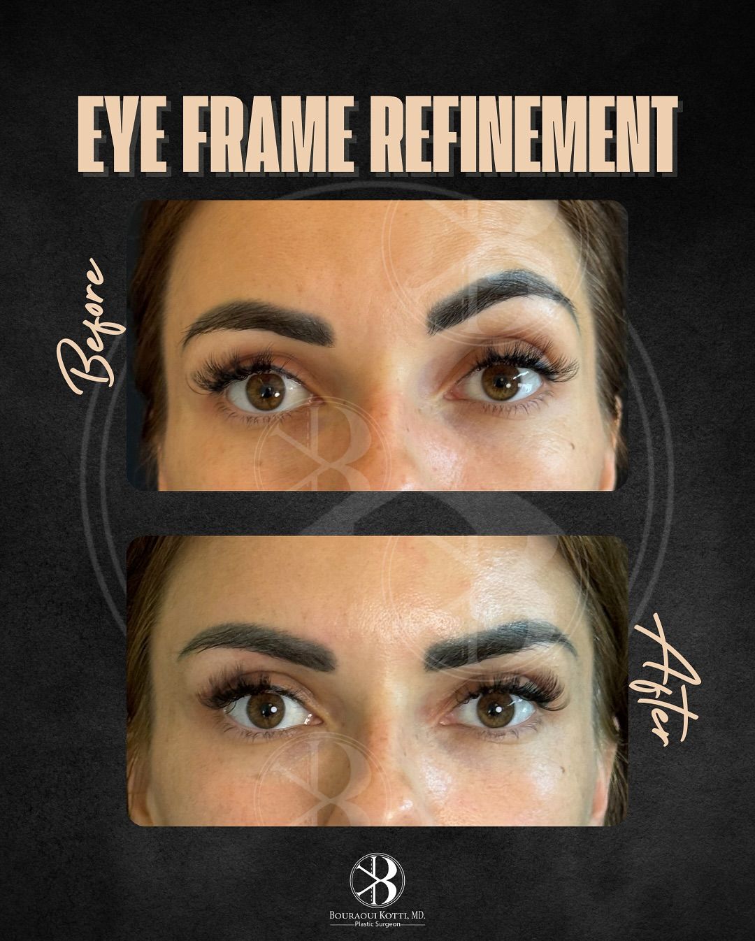 Eye-frame refinement before · after