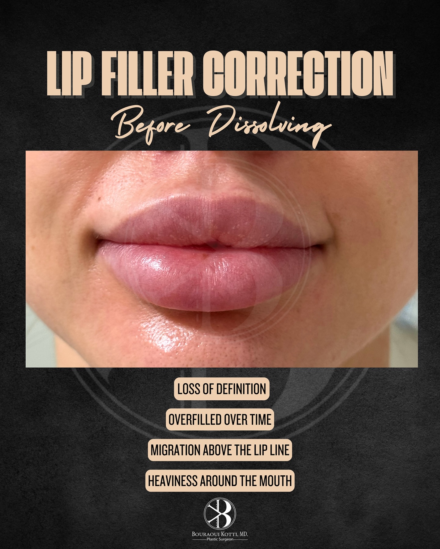 Lip filler correction