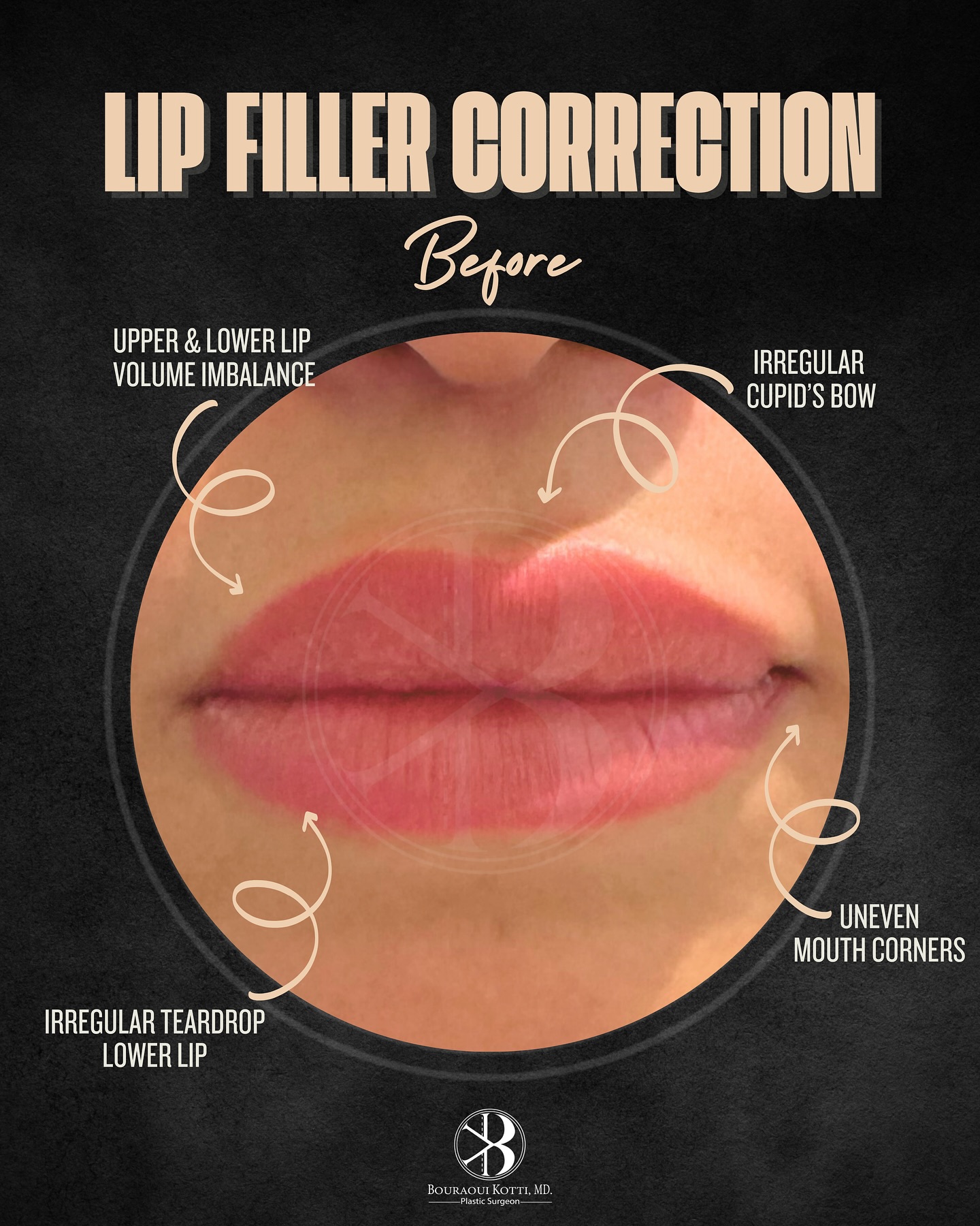 Lip filler correction Dubai — before surgery clinical assessment by specialist plastic surgeon Dr. Kotti | EBOPRAS Certified Surgeon (20)