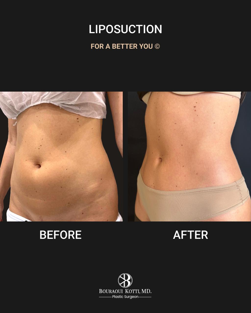 Liposuction