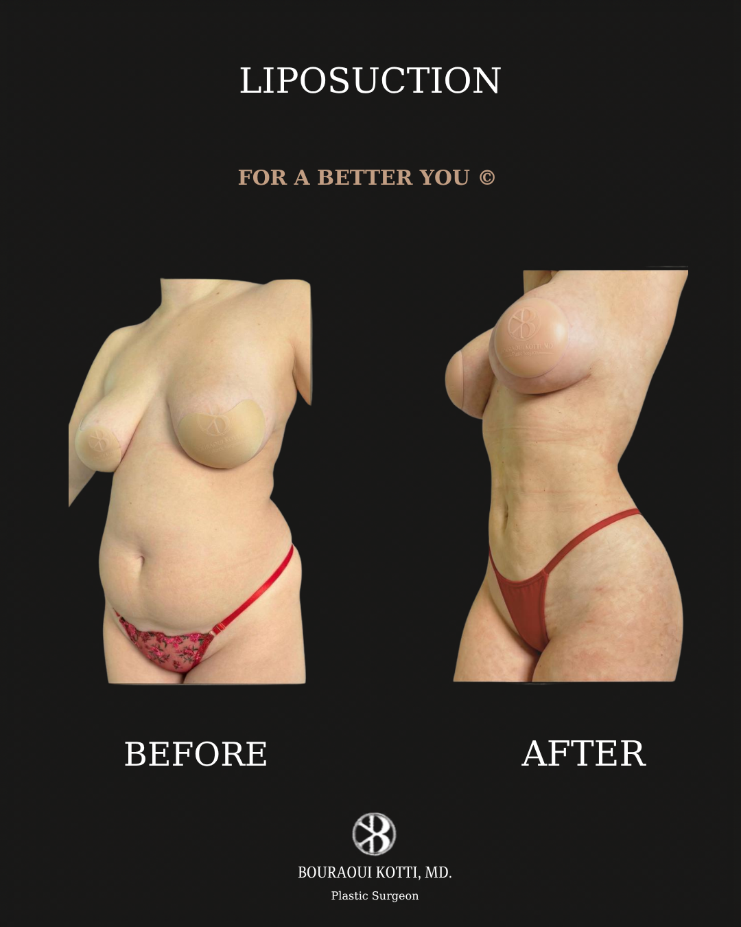 Clinical plastic surgery result — Liposuction Before After