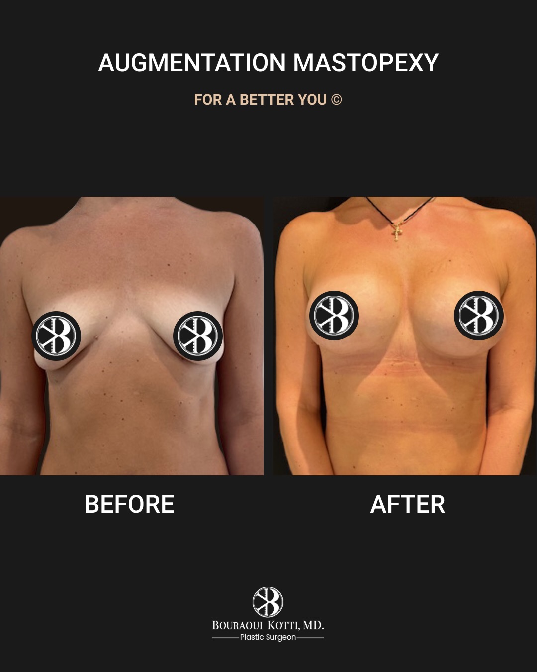Mastopexy augmentation
