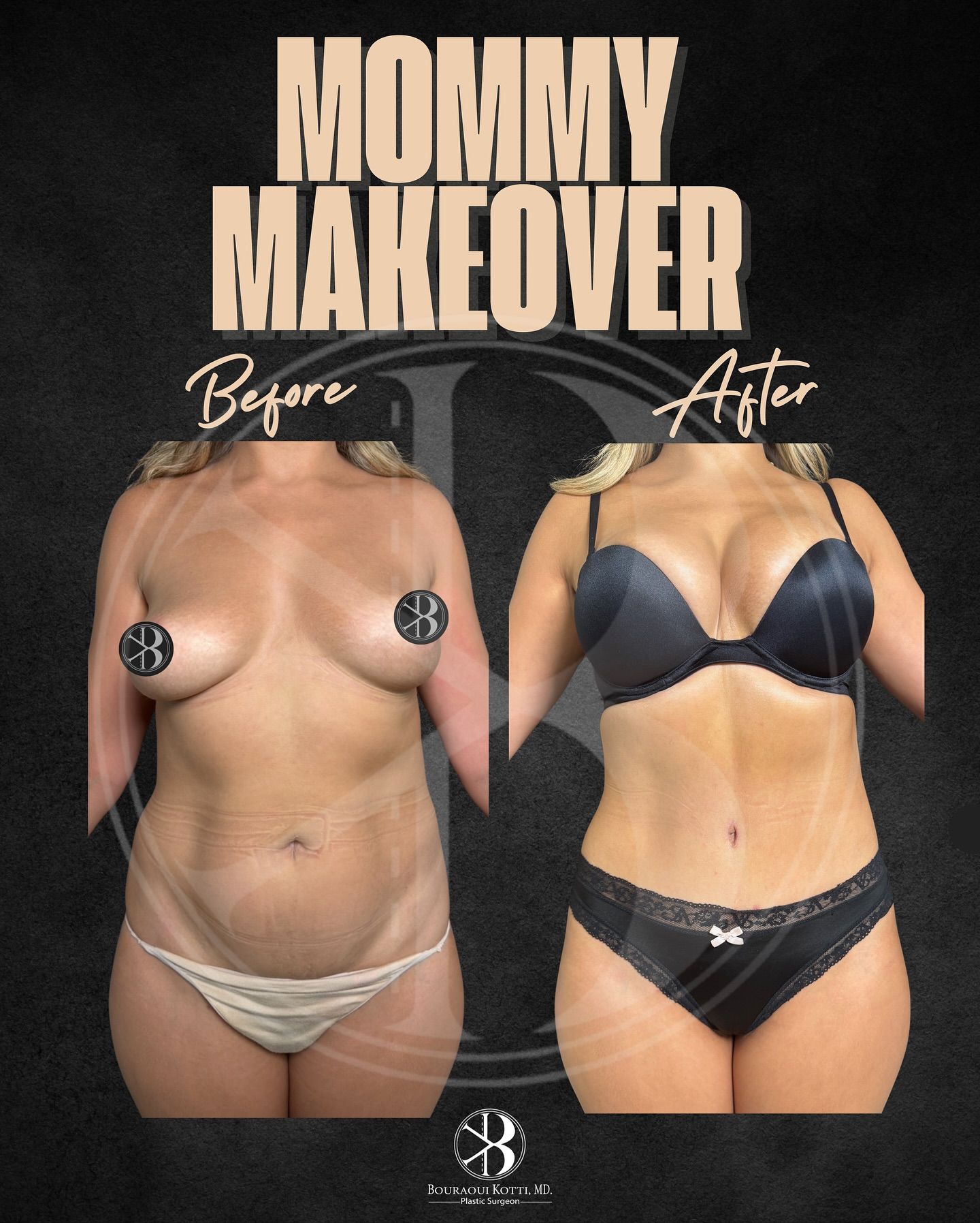 Clinical plastic surgery result — Mommy Makeover