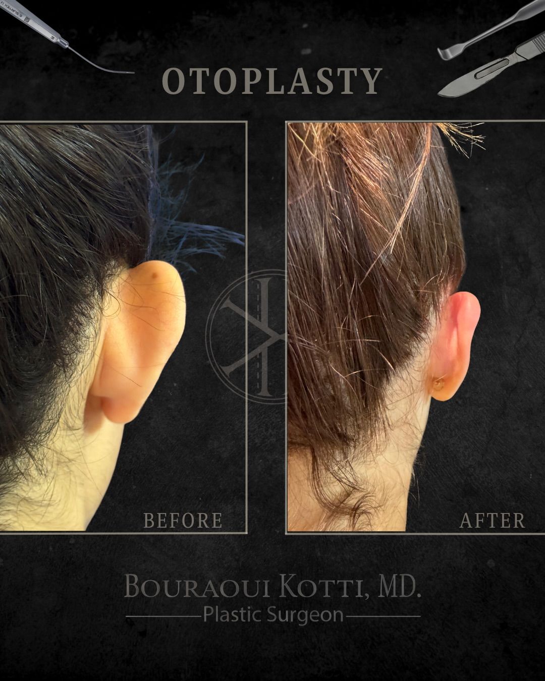 Otoplasty