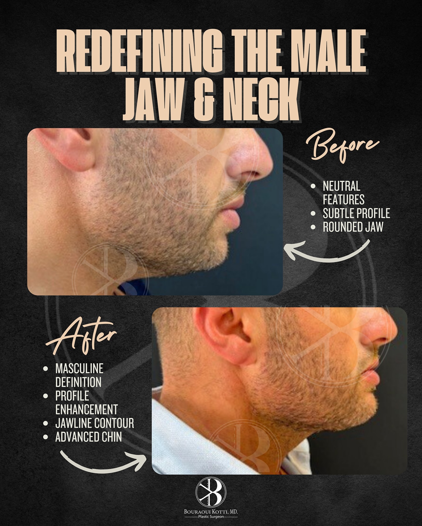 Redefining male jaw and neck Before & After — Dr. Bouraoui Kotti MD PhD, Plastic Surgeon Dubai