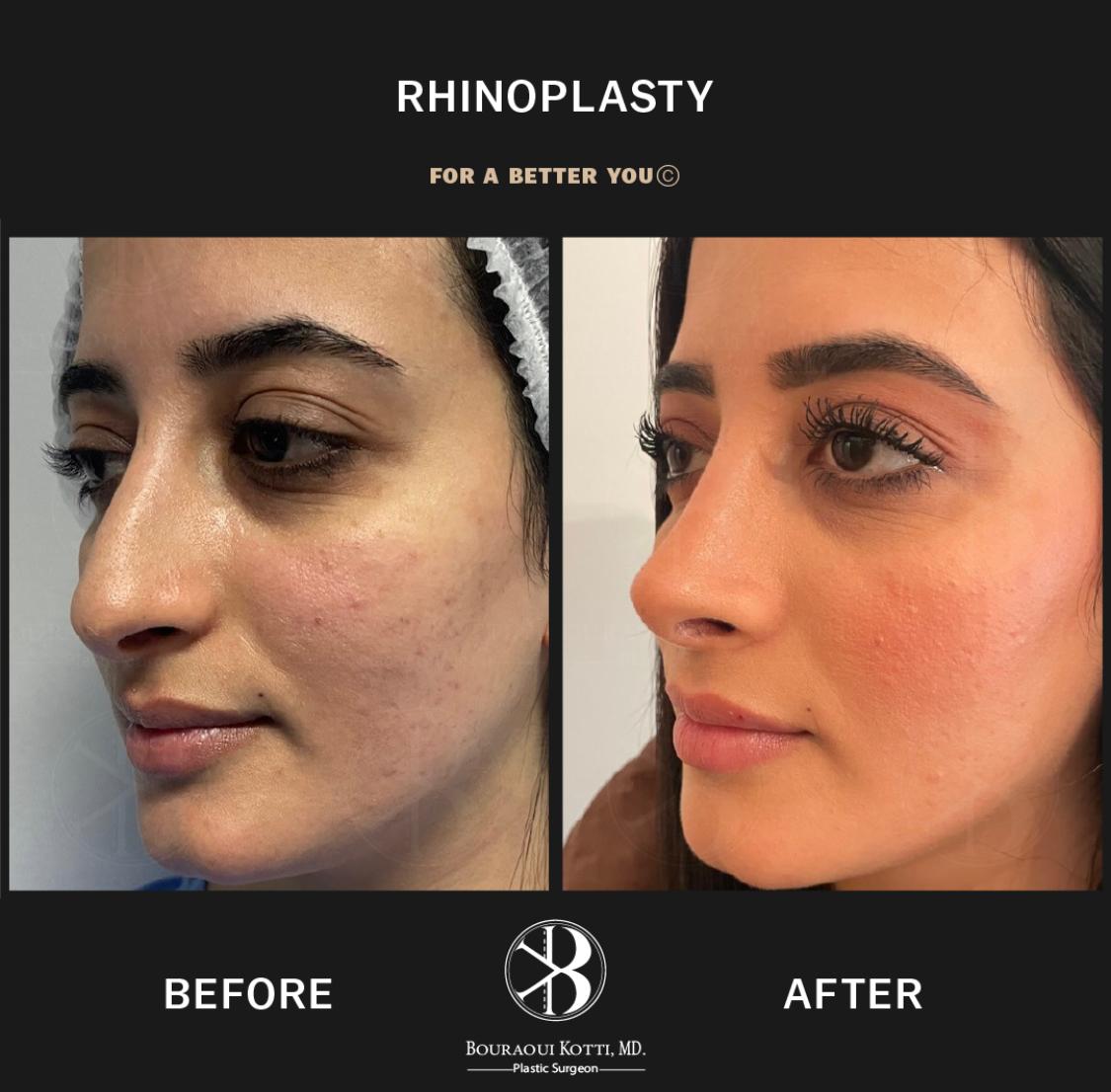 Rhinoplasty