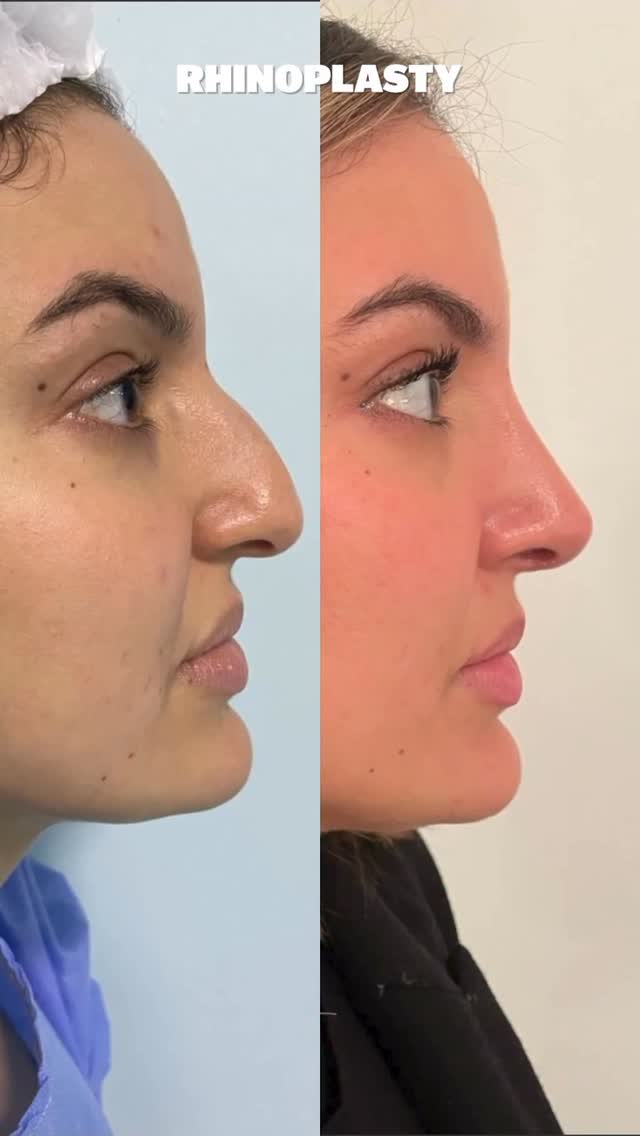Rhinoplasty