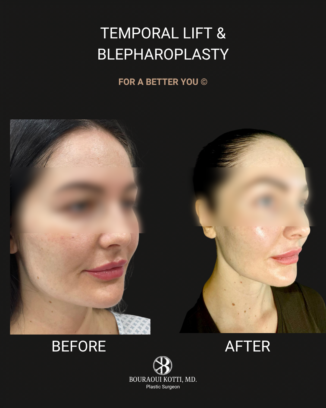 Clinical plastic surgery result — Temporal Lift and Blepharoplasty