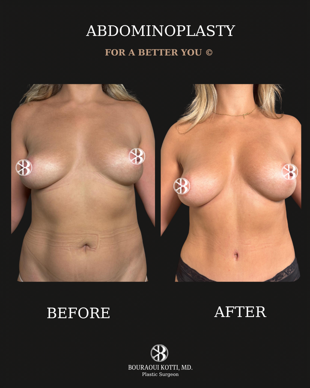 شد البطن before and after clinical result