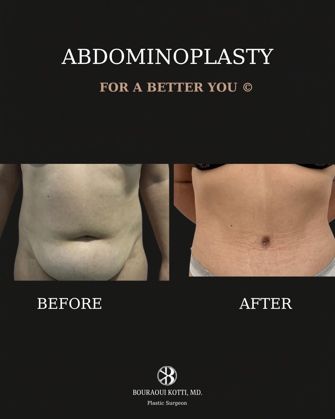 شد البطن before and after clinical result