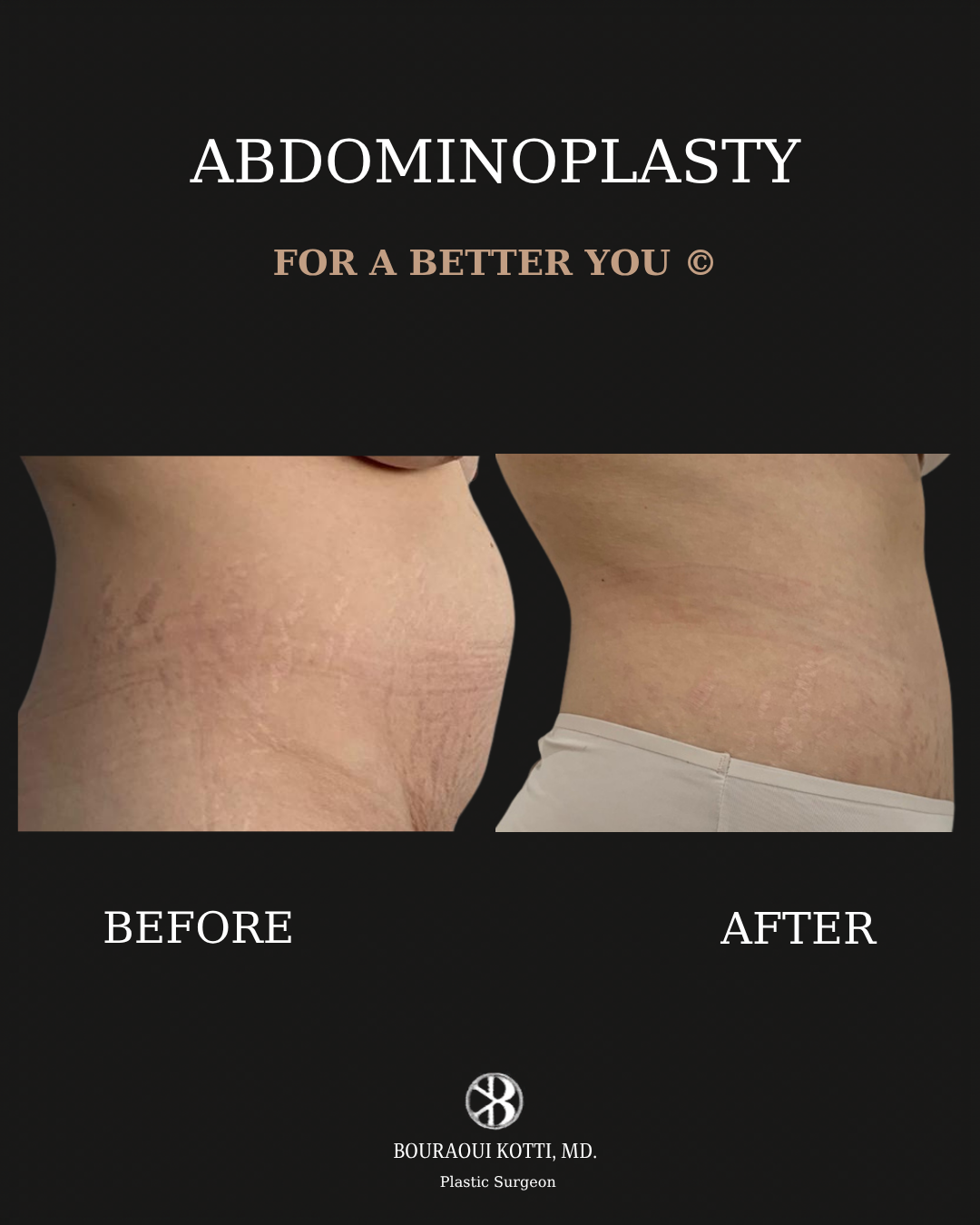 شد البطن before and after clinical result