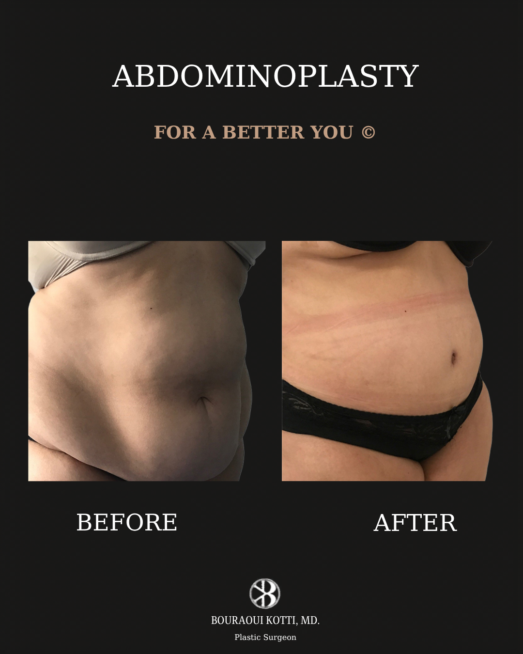 شد البطن before and after clinical result