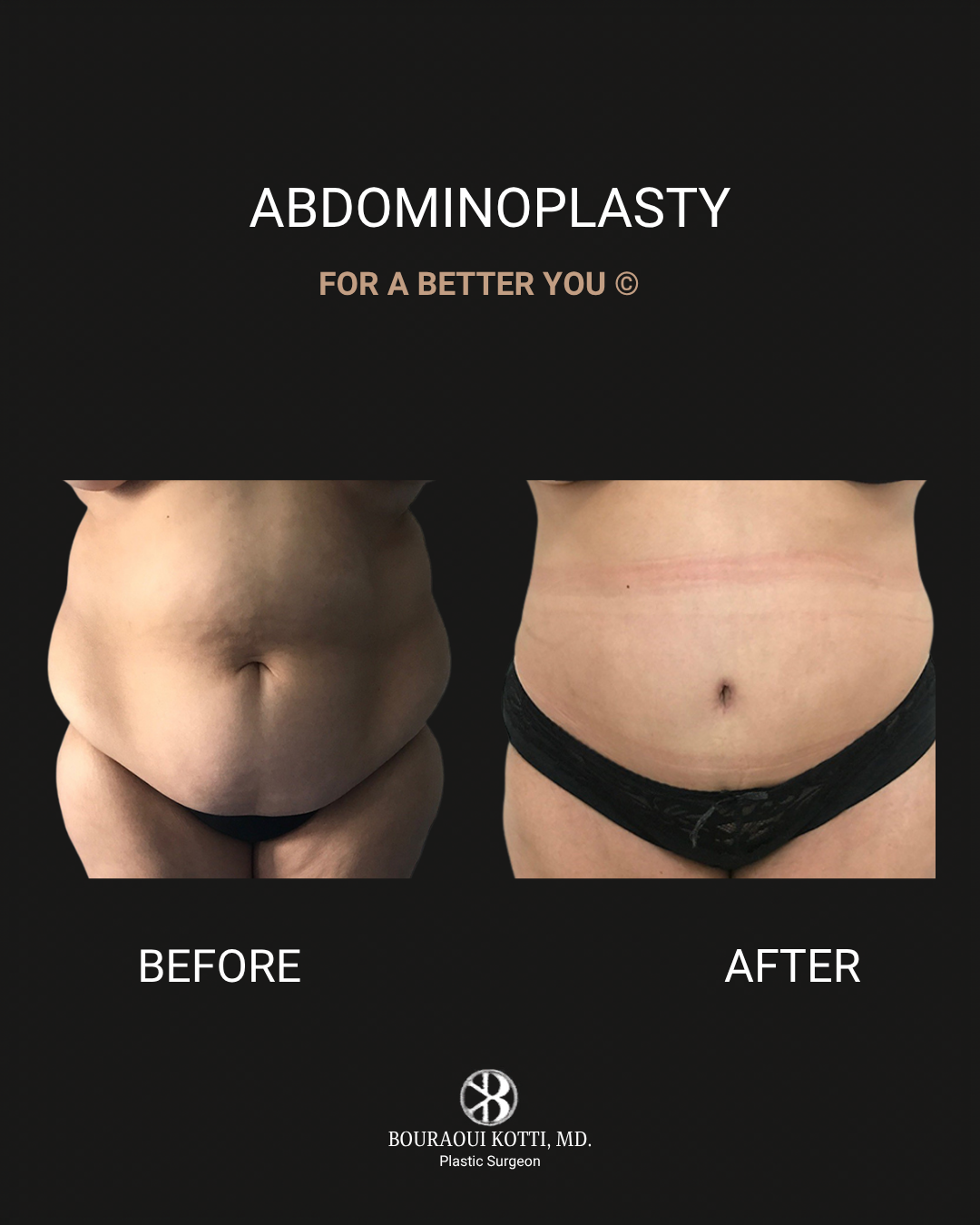 شد البطن before and after clinical result