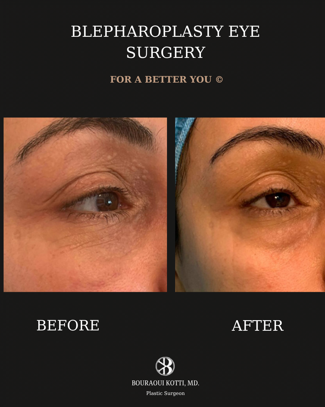 Eyelid Surgery (Blepharoplasty) before and after clinical result