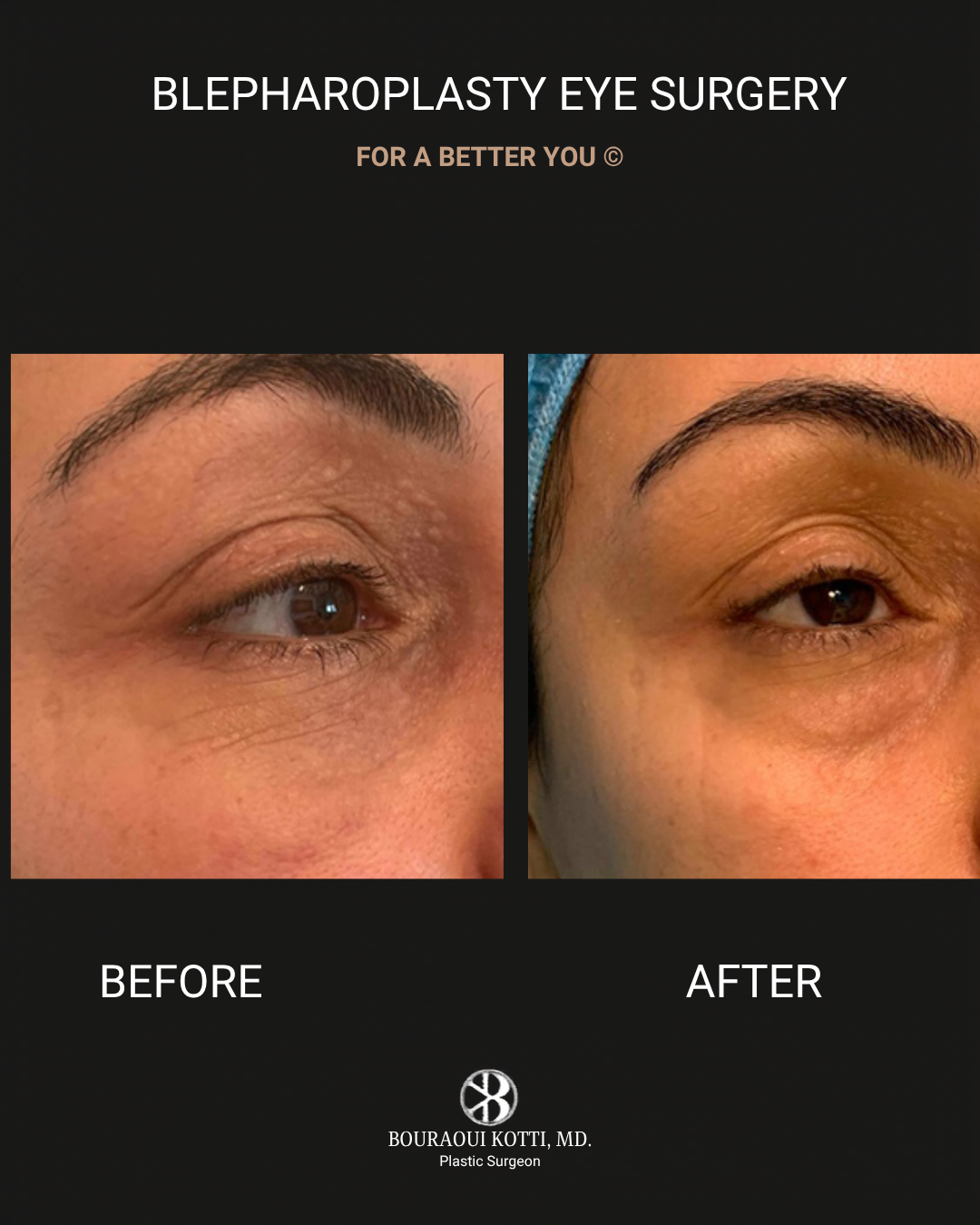 Eyelid Surgery (Blepharoplasty) before and after clinical result