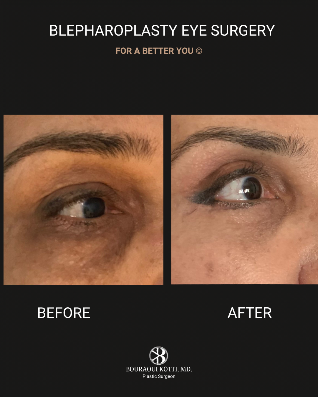 Eyelid Surgery (Blepharoplasty) before and after clinical result