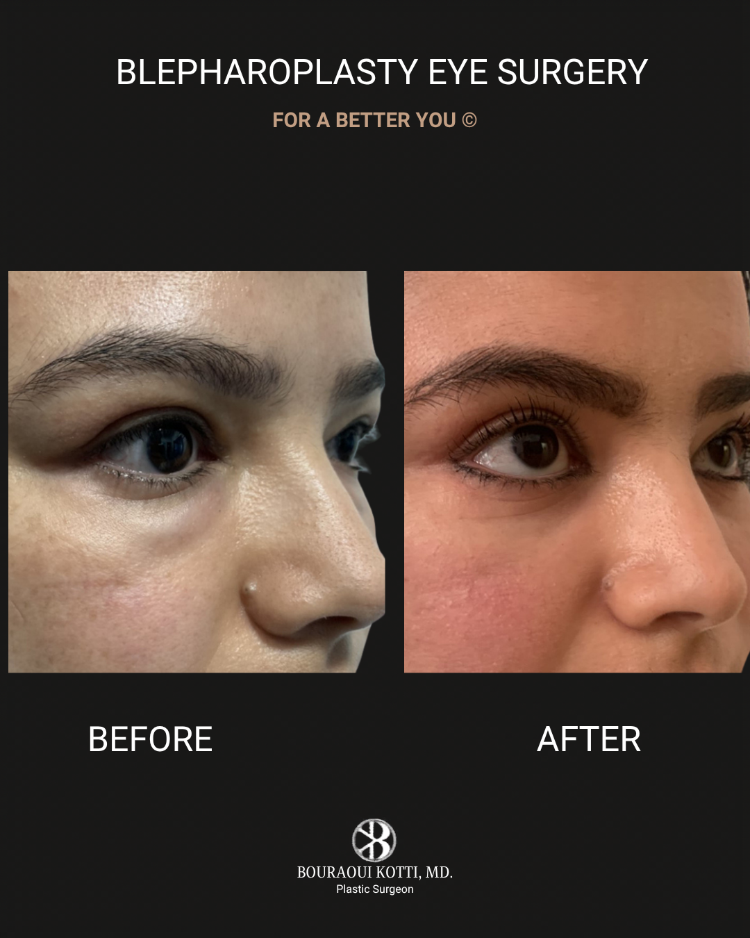 Eyelid Surgery (Blepharoplasty) before and after clinical result