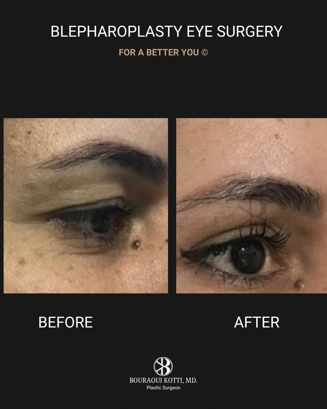 Eyelid Surgery (Blepharoplasty) before and after clinical result