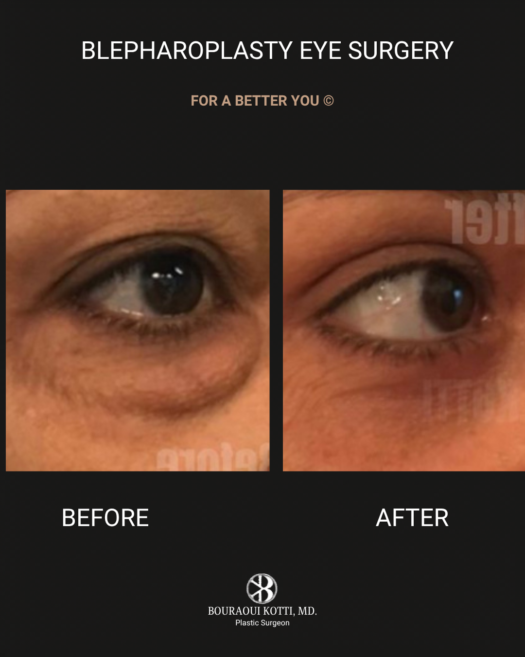 Eyelid Surgery (Blepharoplasty) before and after clinical result