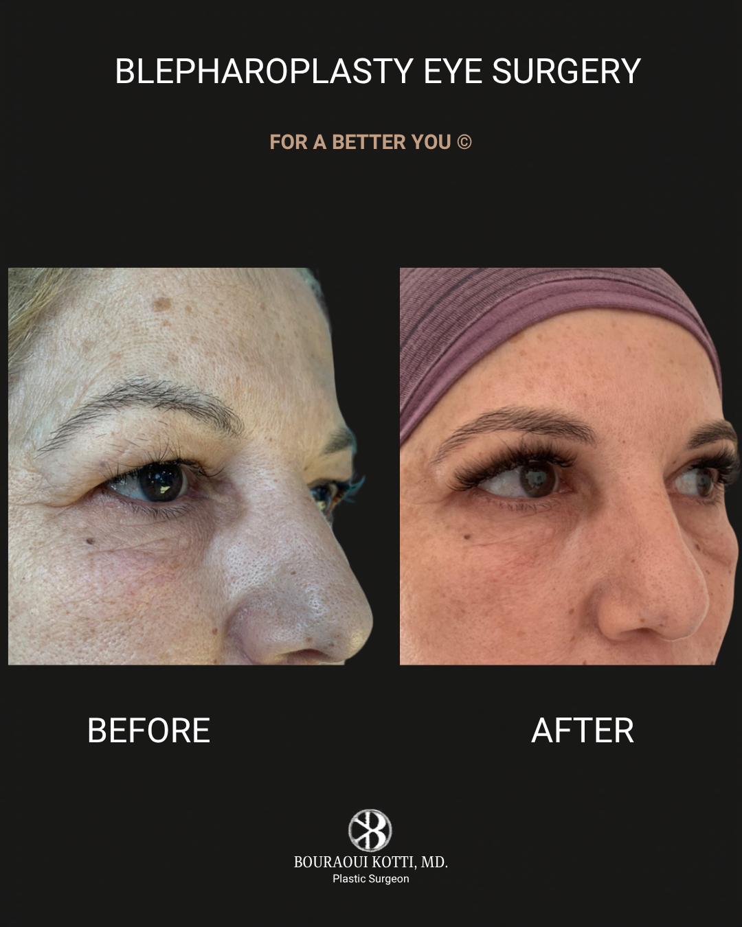 Eyelid Surgery (Blepharoplasty) before and after clinical result