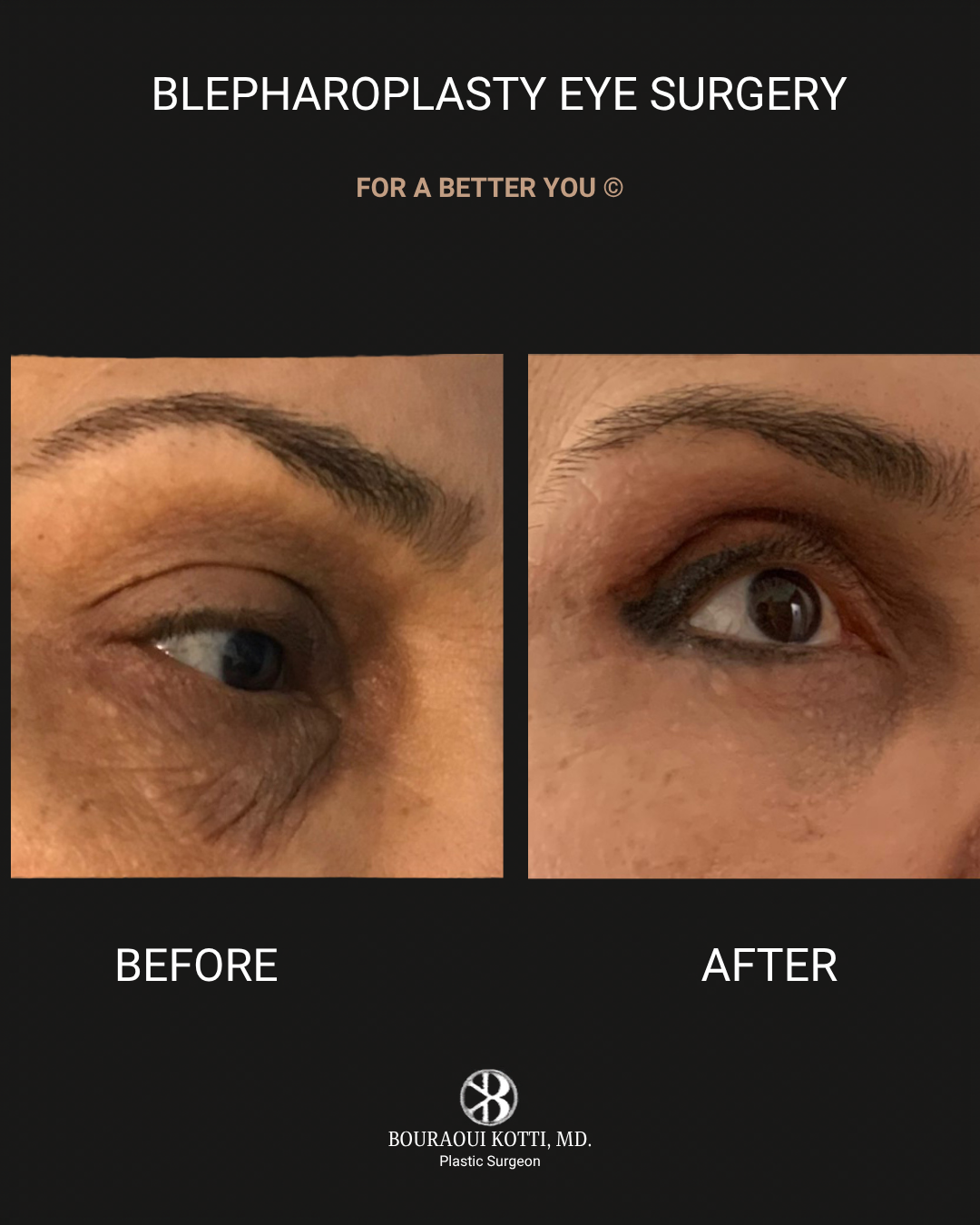 Eyelid Surgery (Blepharoplasty) before and after clinical result