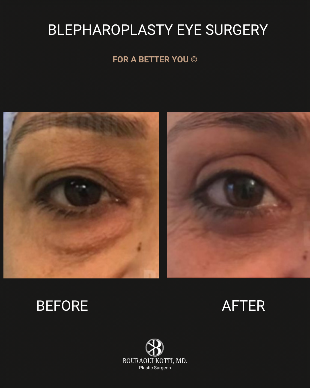 Eyelid Surgery (Blepharoplasty) before and after clinical result