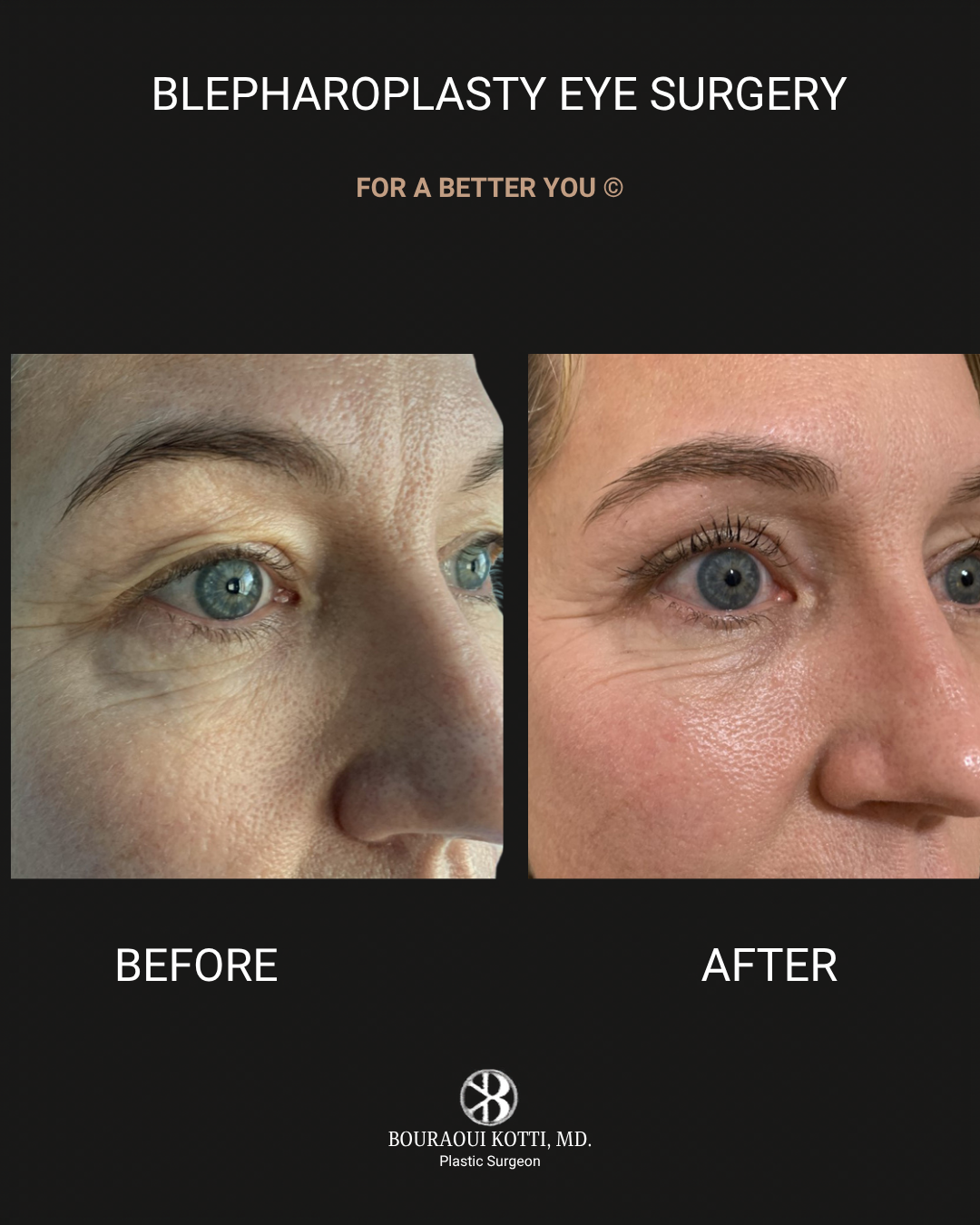 Eyelid Surgery (Blepharoplasty) before and after clinical result