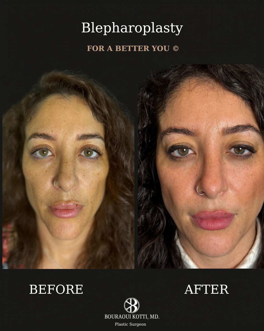 Eyelid Surgery (Blepharoplasty) before and after clinical result