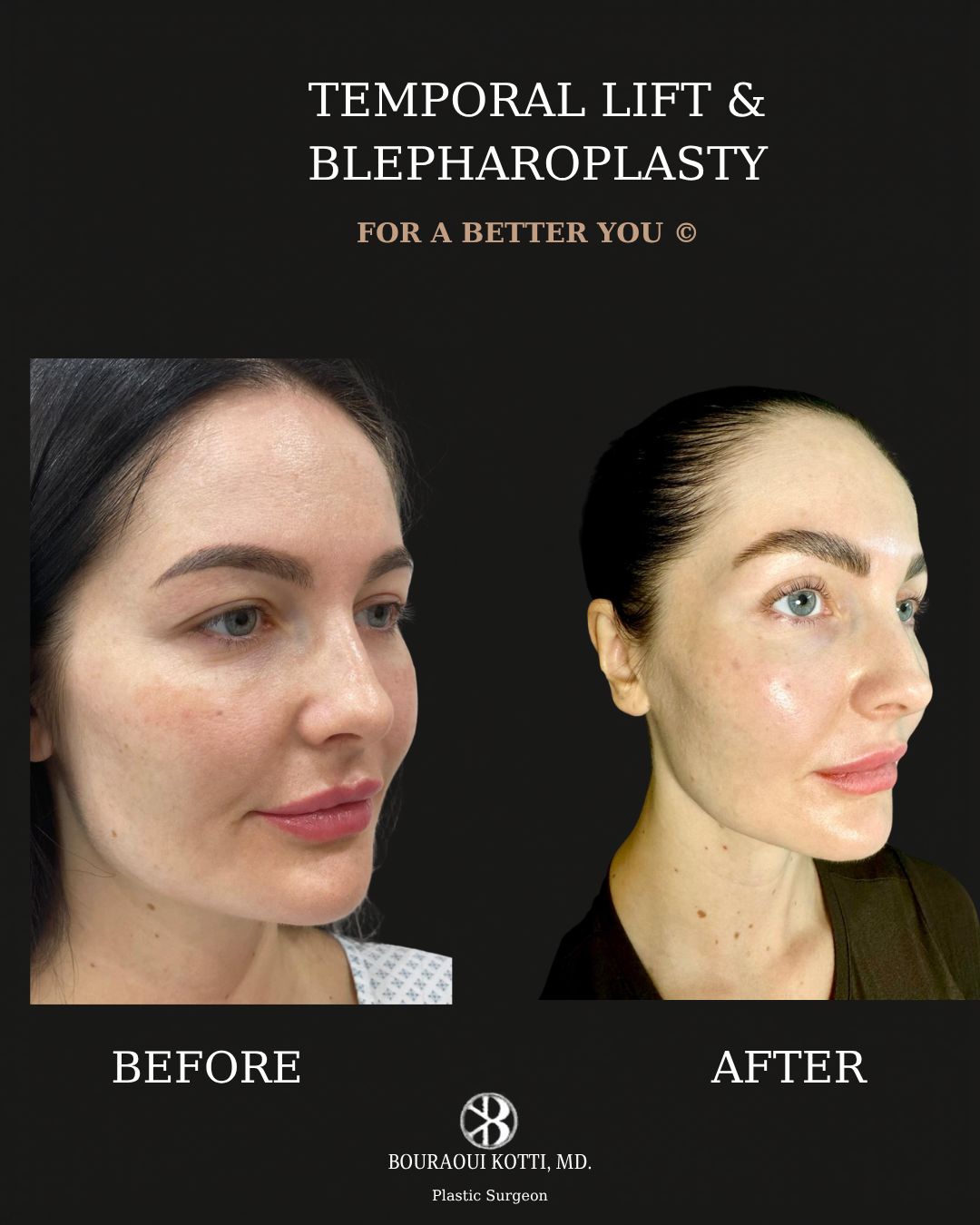 Eyelid Surgery (Blepharoplasty) before and after clinical result