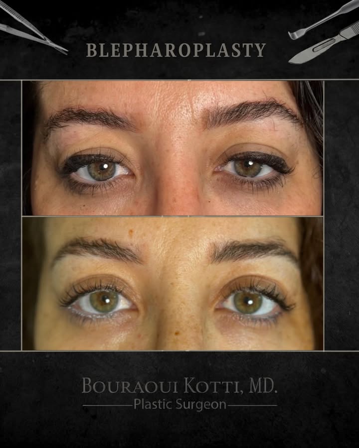Eyelid Surgery (Blepharoplasty) before and after clinical result