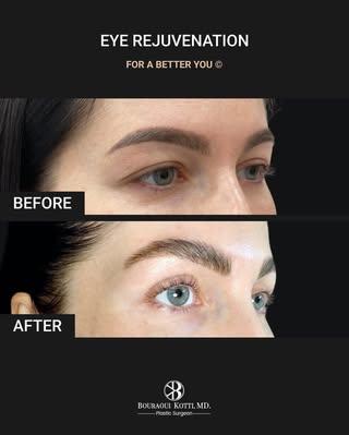 Eyelid Surgery (Blepharoplasty) before and after clinical result