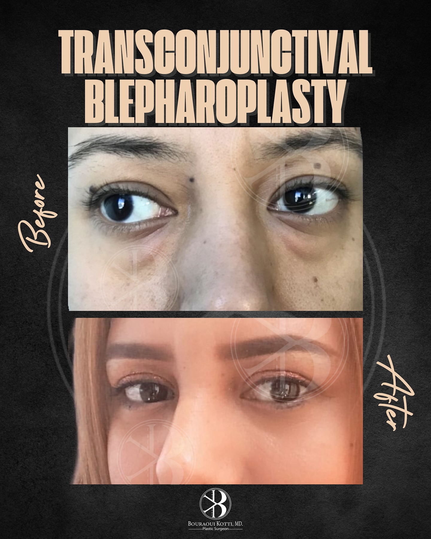Eyelid Surgery (Blepharoplasty) before and after clinical result
