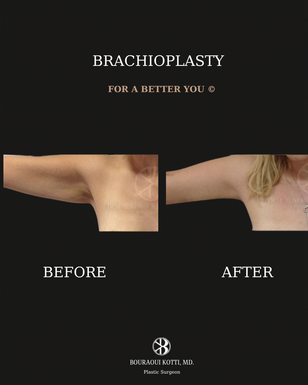 Brachioplasty before and after clinical result