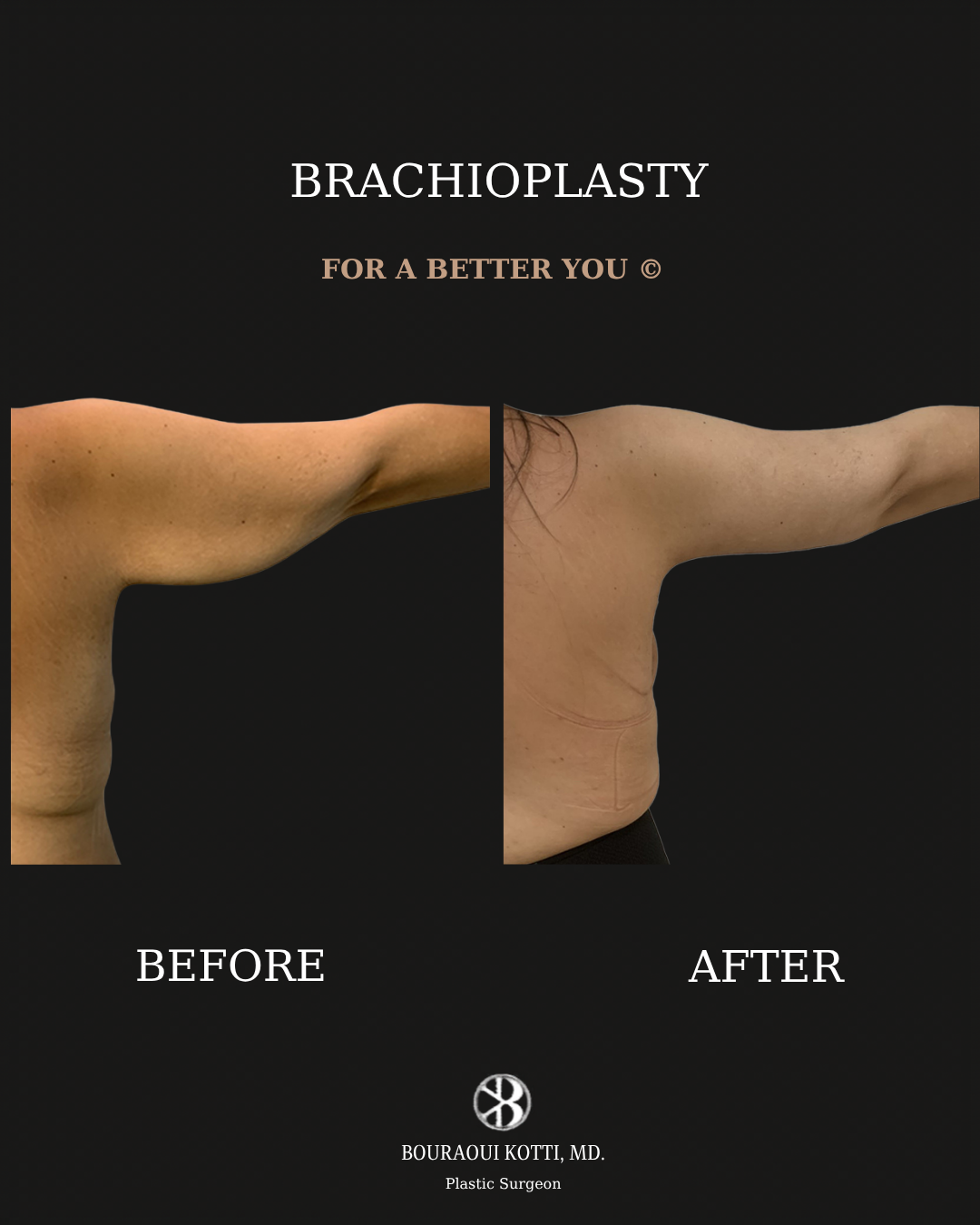 Brachioplasty before and after clinical result