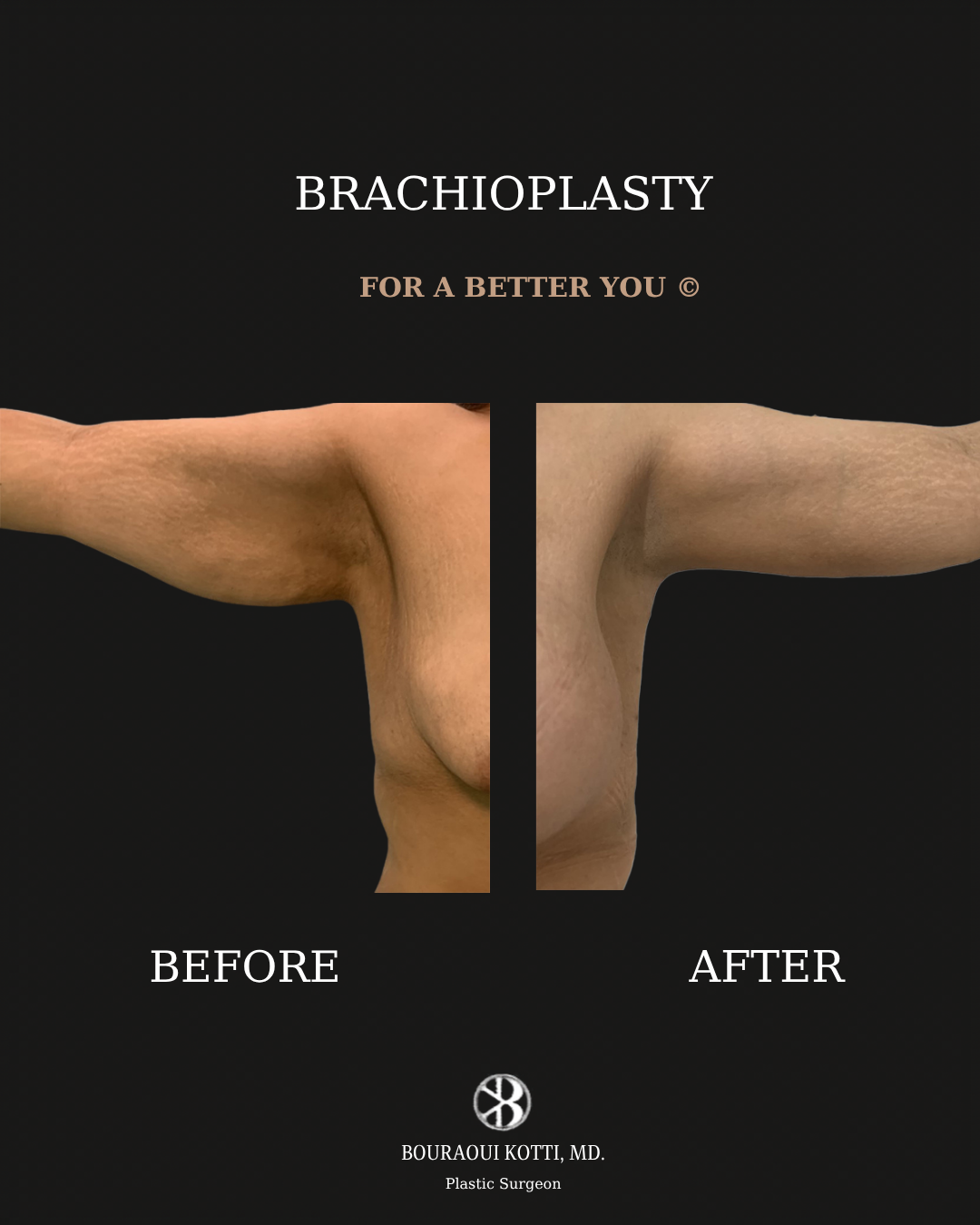 Brachioplasty before and after clinical result