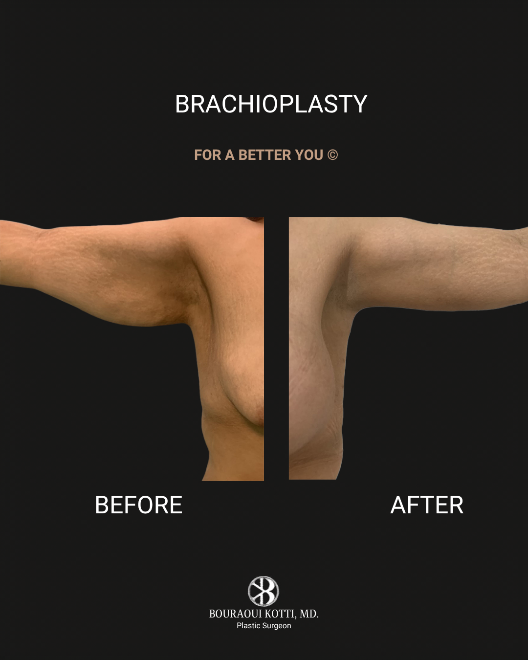 Brachioplasty before and after clinical result
