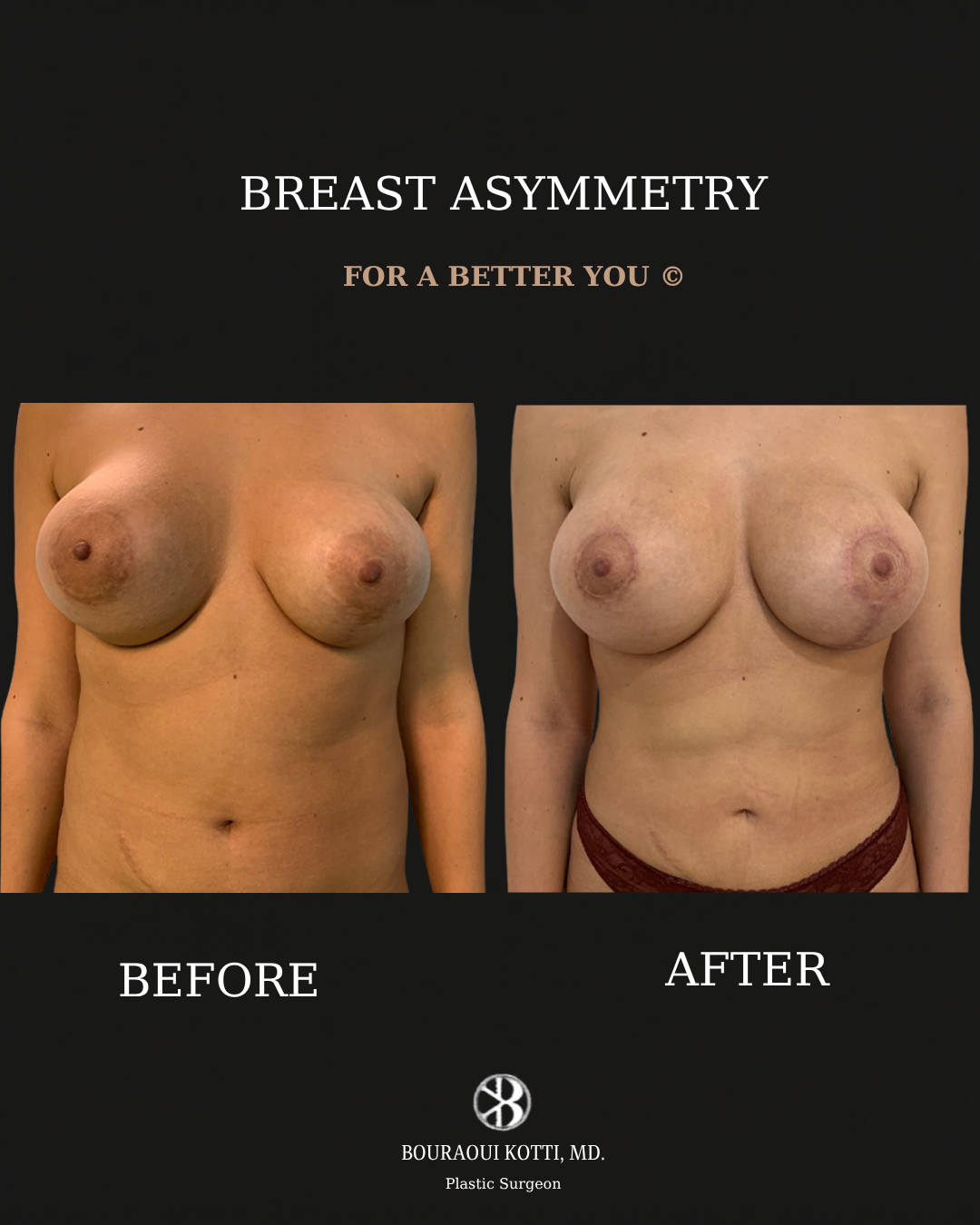 Коррекция асимметрии груди before and after clinical result