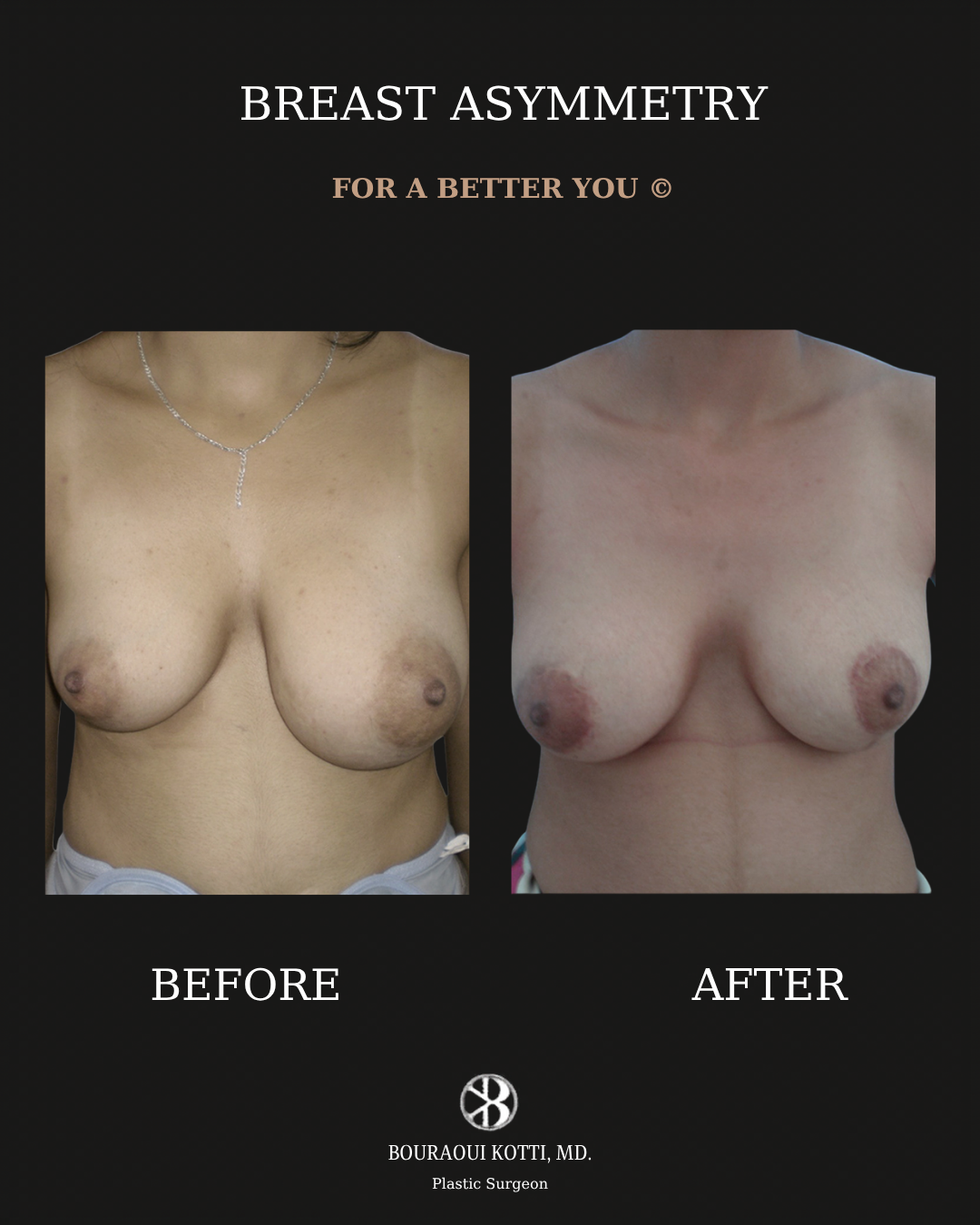 Коррекция асимметрии груди before and after clinical result
