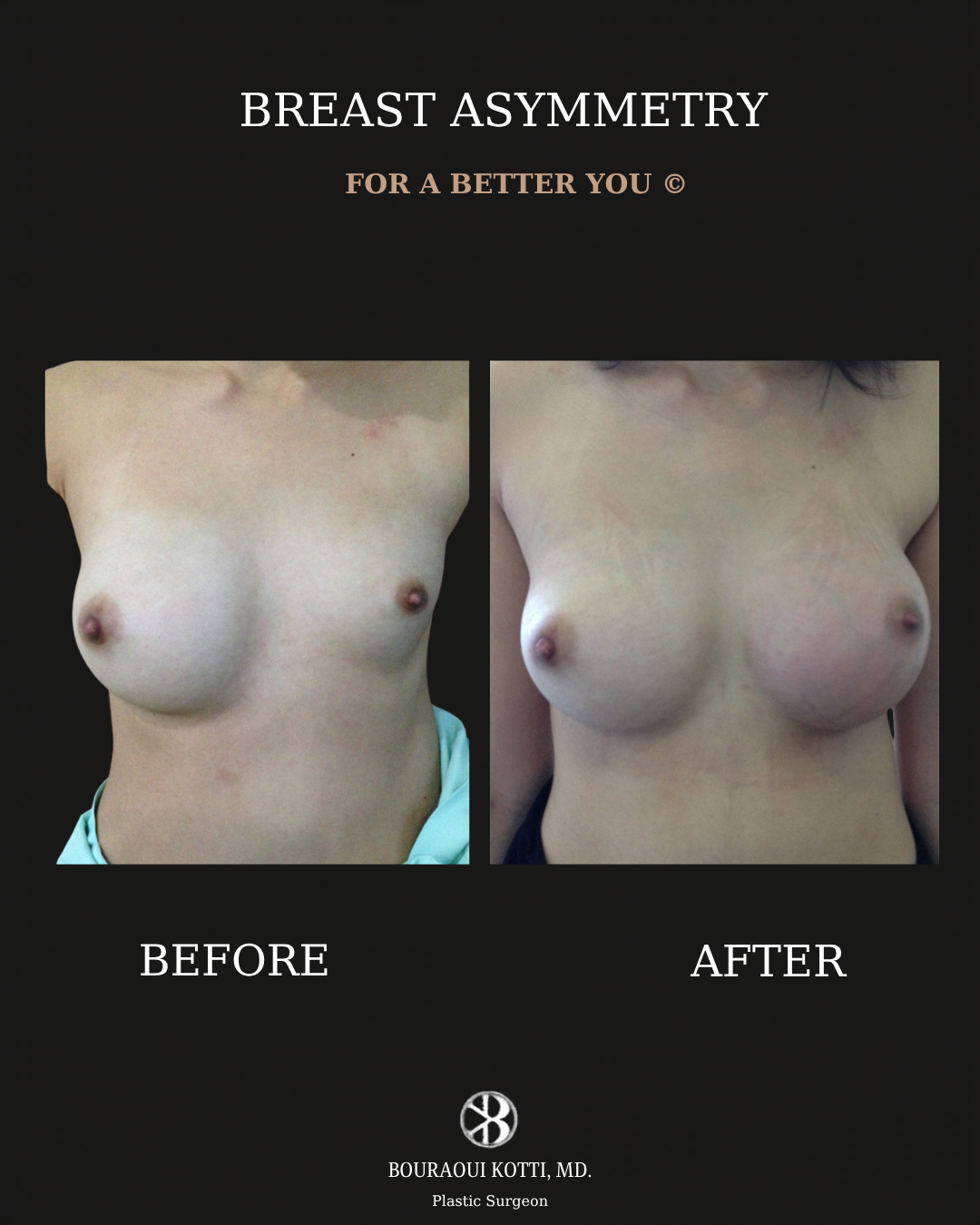 Коррекция асимметрии груди before and after clinical result